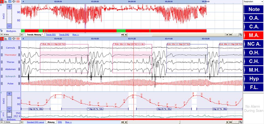 Analysis of ambulatory recordings in SleepRT The SleepRT software is perfectly suitable for PSG analysis of ambulatory signals.