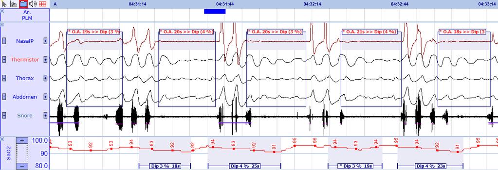 SleepRT Automatic Analyses SleepRT offers Automatic Sleep Analyses in order to speed up the scoring process for PSG recordings. All Analyses are executed according to the latest AASM Guidelines.