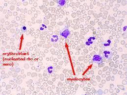 M F: investigation A leucoerythroblastic blood picture is characteristic for idiopathic