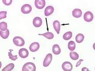 Neutrophilia is common. The blood count is variable.