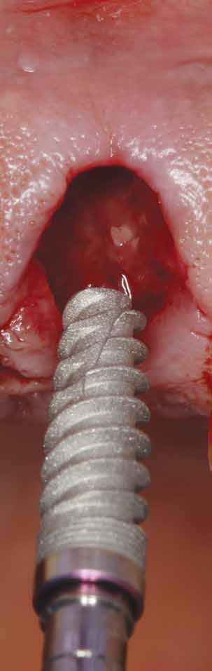 CLINICAL Facial Wall Defect Grafting Techniques in Preparation for a Dental Implant by Timothy Kosinski, DDS, MAGD