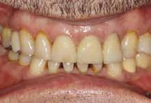 The anterior maxilla presents some challenges. Losing a front tooth can be very traumatic to anyone. Imagine losing a front tooth. There are phychological issues that need to be addressed.