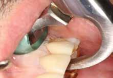 surgical intervention on the patient. However, often time conditions arise where placement of the implant is more challenging.
