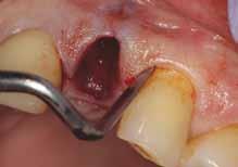 CLINICAL Figure 5: A tooth delivery instrument is used to elevate the tooth out of the socket