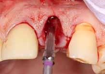 This defect must be corrected to maximize final esthetics and emergence profile of the final