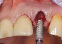 Figure 9: An Orban knife is used to precisely incise the interdental papilla area so exposure of