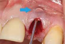 We center mesial and distally between the adjacent teeth and position the initial penetration