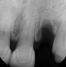 We do not go directly into the socket site, rather are palatally positioned using the palatal wall