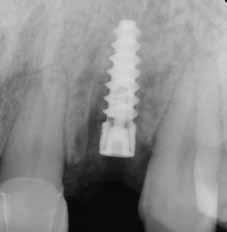Blanching of the tissue is normal as the abutment contours are wider than the