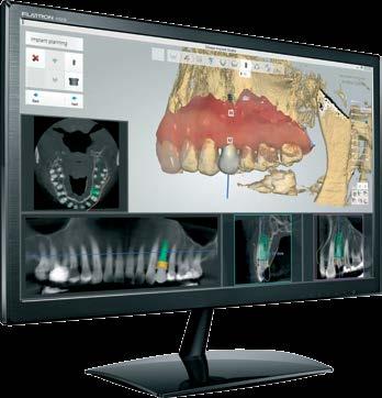 CAD COMPUTER-AIDED DESIGN Using designated software, your data (CBCT and oral surface scan) will be merged to a full 3D model of