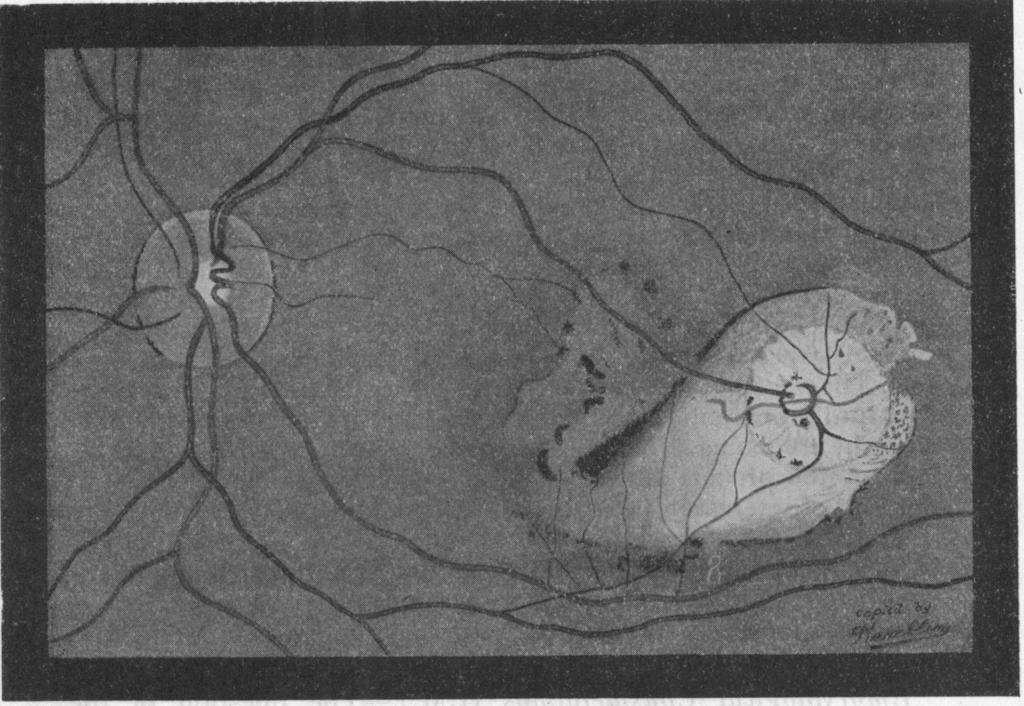 ATYPICAL COLOBOMA WITH ABNORMAL RETINAL VESSELS 609 FIG. 1. Drawing, after Beaumont, of a macular coloboma showing abnormal anastomosis of vessels.