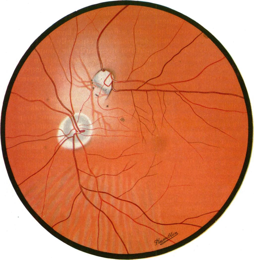 ;K,-a FIG. 2. Appearance of the Fundus in the present case. Br J Ophthalmol: first published as 10.
