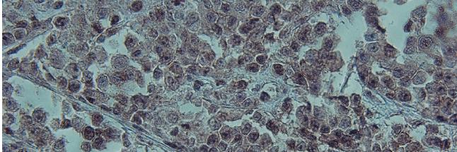Sternberg cell was frequently shrunken away from the surrounding dense background of lymphocytes or fibrous