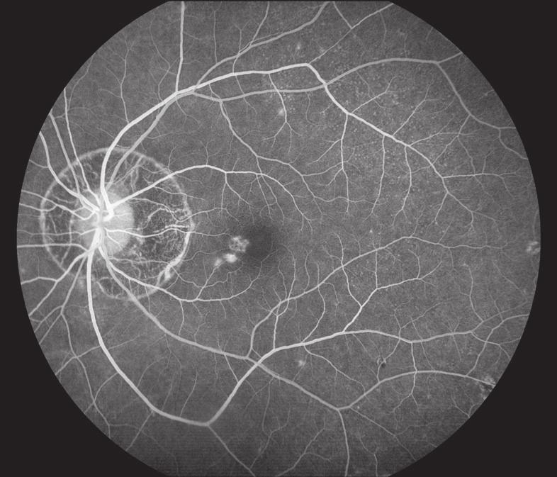 A B C D E Figure 1. Vitreous haze and chorioretinal atrophy consistent with multifocal choroiditis. Blue arrow indicates yellow-white lesions in the macula (A).
