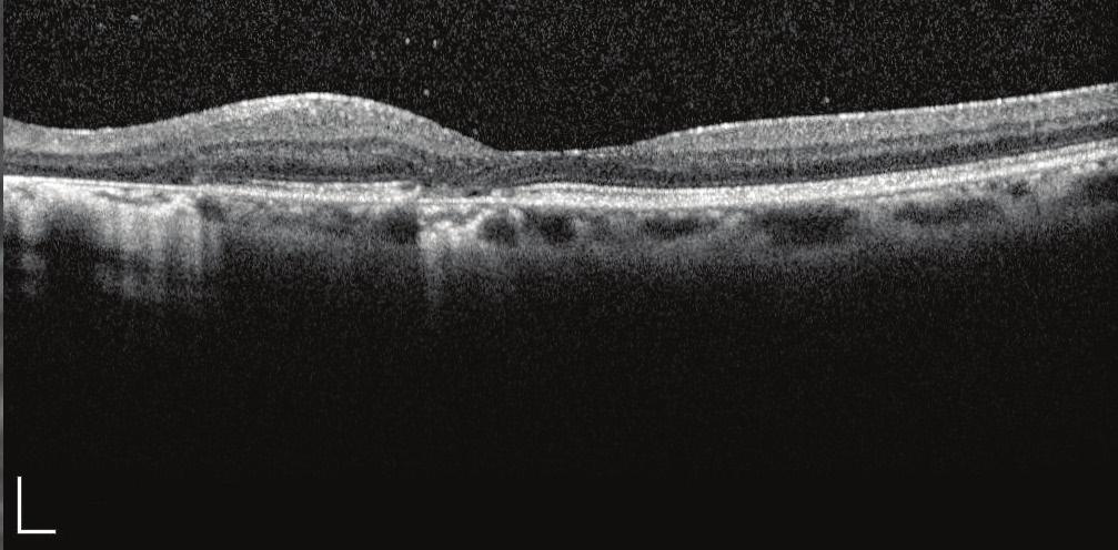 DIAGNOSIS: The patient had a previous medical history of hypertension, asthma, anemia, as well as cataract surgery with intraocular lens implantation.