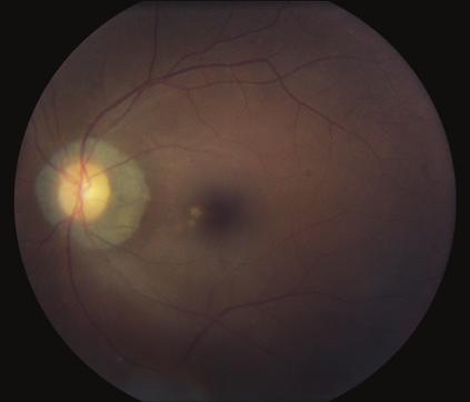 posterior pole, suggestive of window defects in the retinal pigment epithelium (RPE) (Figure 2).