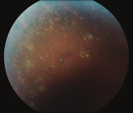 Additionally, areas of atrophy were visible in the macula temporal to the fovea, and the areas of RPE atrophy were consistent with the multifocal choroiditis