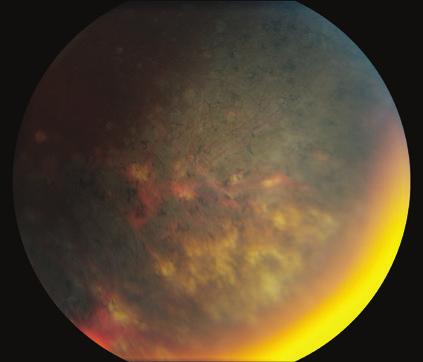 All clinical signs were suggestive of noninfectious posterior uveitis or panuveitis, and the patient was ultimately diagnosed with unilateral multifocal
