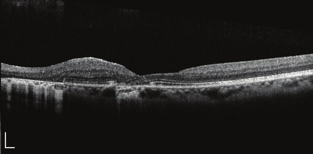 1 Considering that the patient s vision was still intact, aggressive treatment was critical to preserve her vision and help prevent future vision loss.