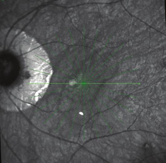 Systemic therapy is often prescribed for patients with bilateral multifocal choroiditis, but it may not be appropriate for patients with single-eye involvement and no other organ systems involved.