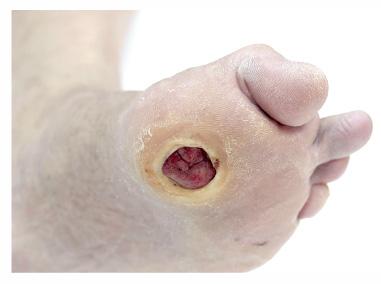 Diabetic foot ulcers can result from small cracks and cuts on the foot that go unnoticed because of nerve damage.