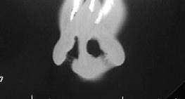 septal hematoma Patient should be seen by