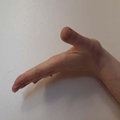 Wrist and thumb in neutral, fingers extended.