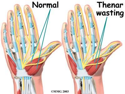 A traumatic wrist injury may cause swelling and extra pressure within the carpal tunnel.