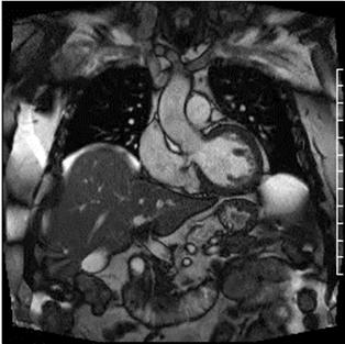 Gerbode Defect More often repair of the VSD Endocarditis Aortic insufficiency