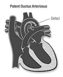Patent Ductus Arteriosus Coarctation of Aorta Significant Left