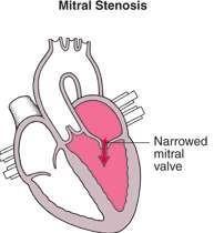 Pathophysiology Narrowing of mitral valve left atrial pressure Hypertrophy left atrium blood flow to left ventricle pulmonary