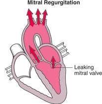 Pathophysiology Incomplete closure of mitral valve Backflow of blood to the left atrium vol.