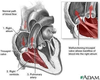 tricuspid valve allows blood to flow back into the right atrium