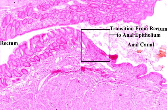 CERVICAL CANCER/ANAL CANCER BOTH RELATED TO HPV BOTH PRECEDED BY INTRAEPITHELIAL LESIONS BOTH ARISE IN