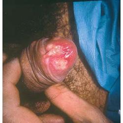 Dermatological conditions Erythema Multiforme Aphthous ulcers Fixed