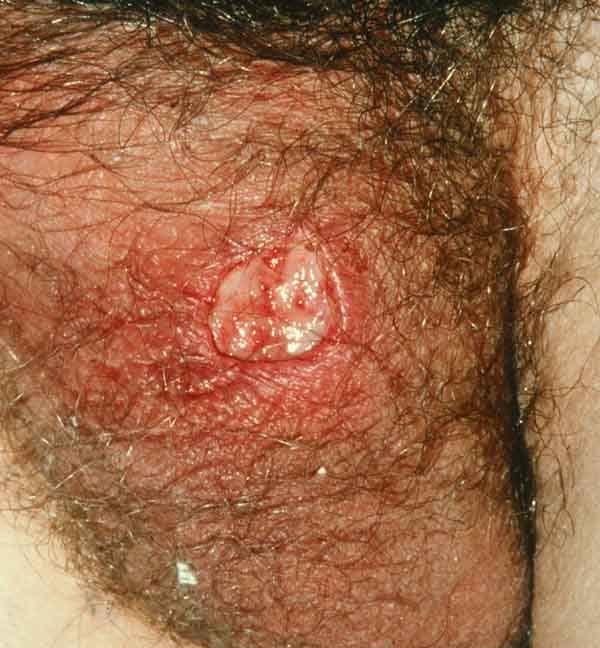 Behçets Syndrome Ulcers - painful, persistent, punched out Rash - papulopustular or acneform,