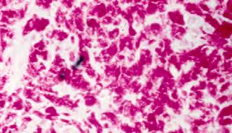 Disseminated Mycobacterium-avium avium complex (MAC) disease in AIDS Common in environment (water). Local lung disease known prior to AIDS. Widespread visceral dissemination in AIDS.