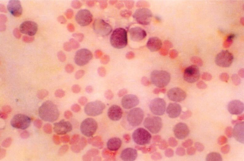 Fig. 3 FNAC from Ewing s sarcoma showing rounded cells with hyperchromatic nuclei (H & E 40x X 10x) Fig.