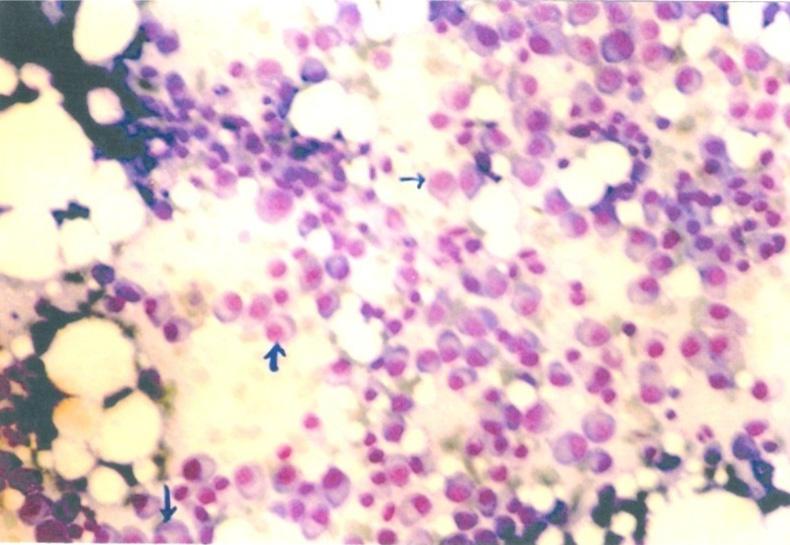 5 FNAC from metastatic deposits in bone showing clumps of round to polygonal cells containing hyperchromatic nuclei (Leishman 40x X 10x) Fig.