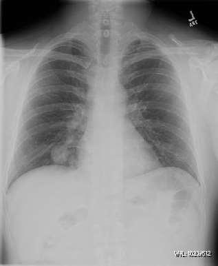 Pulmonary Metastasectomy: Complex Multiple Diseases & Histologies Combined modality therapy Involvement of pulmonary lymph nodes Repeat pulmonary resections
