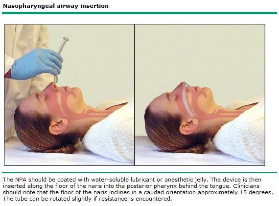 used in responsive patients. b. Size: measure from corner of the mouth to angle of the jaw. c. Placement: take care not to push tongue back into throat and obstruct the airway.