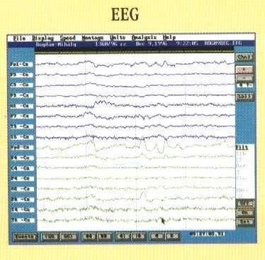 illness Electroencephalogram (EEG) a device that records the electrical activity of the brain.