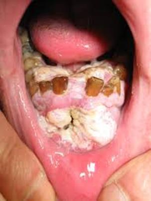 Oral Cancer Disorder in which body cells lose the ability to control growth. Cancer cells do not respond to the signals that regulate the growth of most cells.
