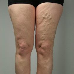 Recurrent varicose veins are known to be a common problem after surgery. The incidence of those patients with recurrent veins after surgery is reported to be between 20-80% [1-4] 1] L. Jones, B. D.