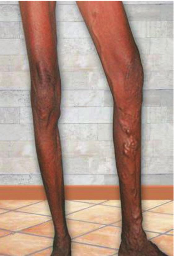 Figure-1: Varicosity of great saphenous vein Figure-2: Technique of foam preparation using two syringes and one triway Figure-3: Procedures in foam sclerotherapy varicose veins.
