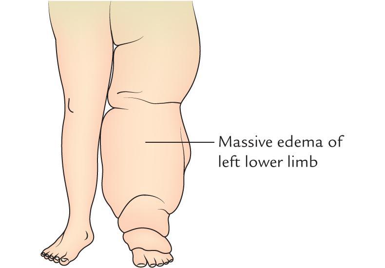 Clinical Anatomy Elephatiasis:- The lymph vessels of the lower limb are often blocked, particularly in the endemic area, by the microfilarial parasites (Wuchereria bancrofti).