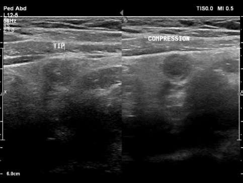 3. Split image of appendix without and with compression. Note echogenic fat around appendix. 4.