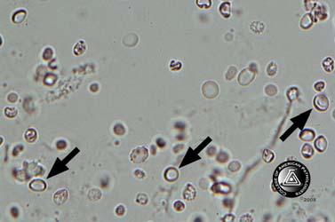 Urine Sediment Photomicrographs/Photographs Case History CMP-18 This urine sample is from a 48-year-old male with a 30-year history of diabetes mellitus and new onset renal failure.