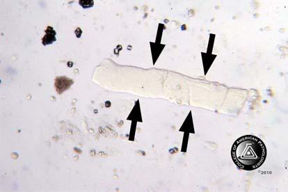 Urine Sediment Photomicrographs/Photographs Case History CMP-19 This urine sample is from a 48-year-old male with a 30-year history of diabetes mellitus and new onset renal failure.