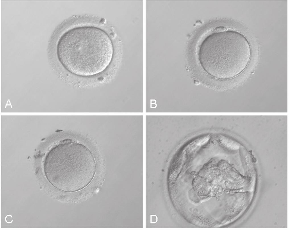 Figure 1. Rescued in-vitro maturation, oocyte cryopreservation, and preimplantation development of a representative human oocyte. (A) A denuded oocyte at germinal vesicle stage.